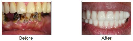 Dental Implants Before and After | Dr. Dean Glasser | Melville