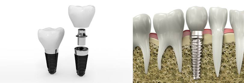 Dental Implants | Implant Dentistry Long Island