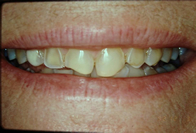 Smile Before