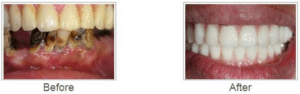 Before and After Dental Implants Melville NY Before and After Dental Implants Melville NY