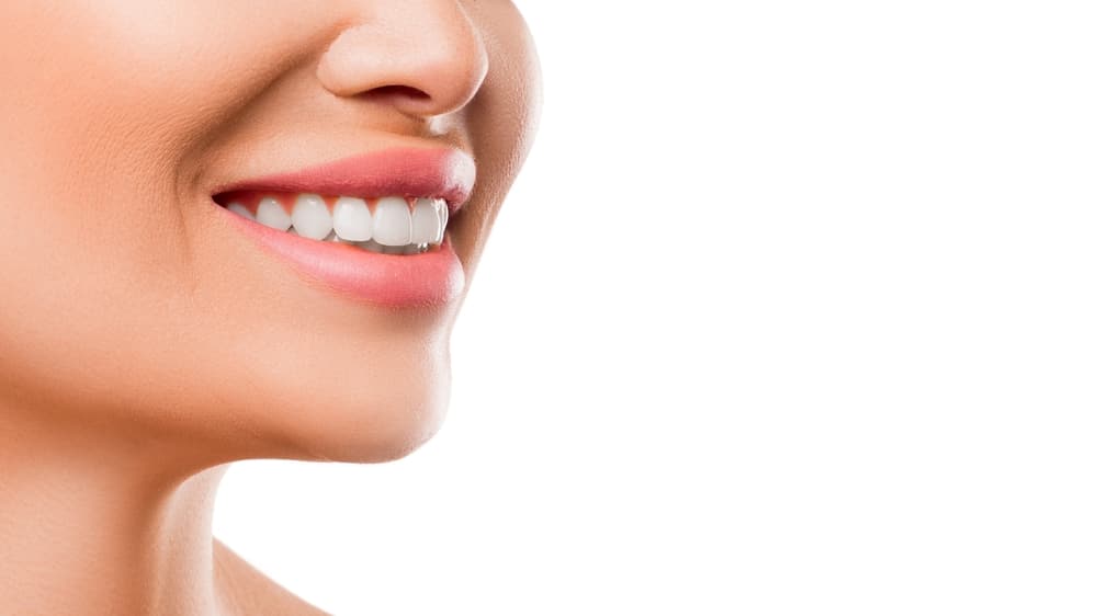 A close-up shot of a woman's smile after getting implants with the X-Guide system