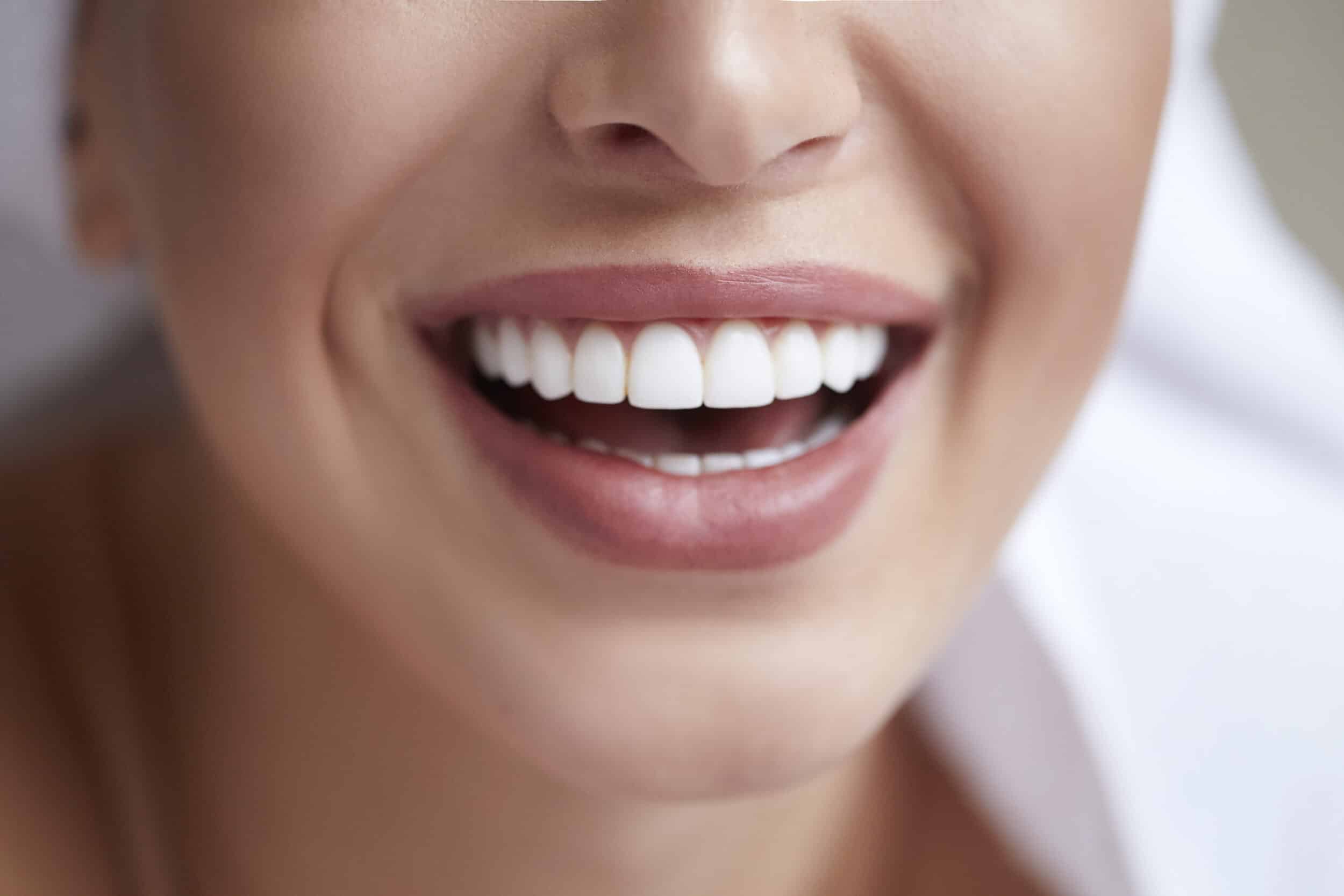 A close-up shot of a woman’s smile after teeth whitening in Nassau County
