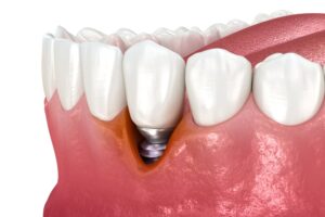 dental implant gum recession dental implant gum recession