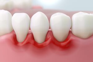 gum irritation and recession gum irritation and recession