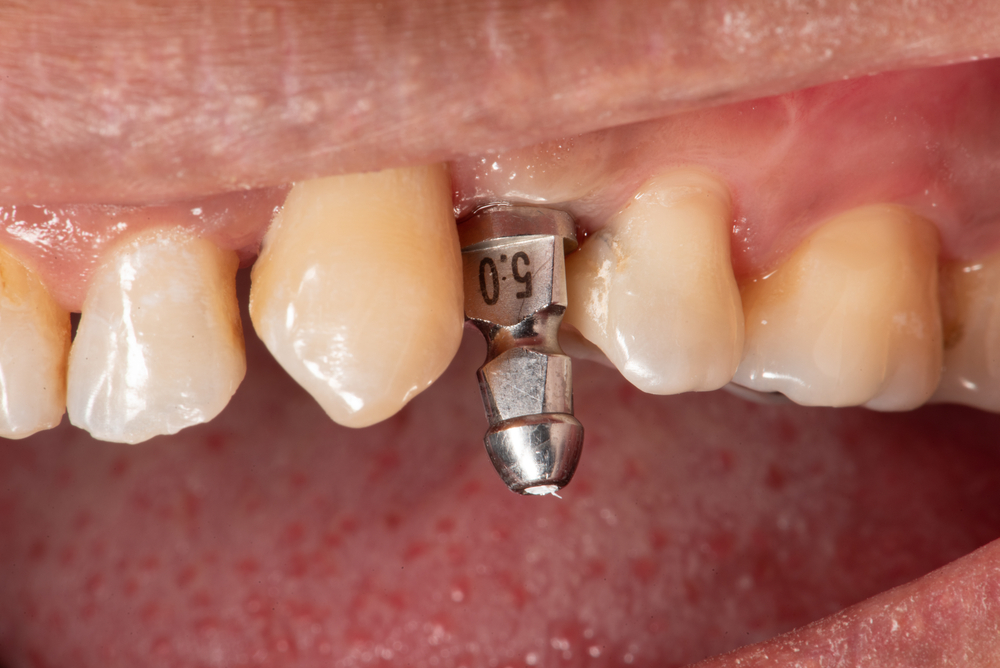 dental implant without crown