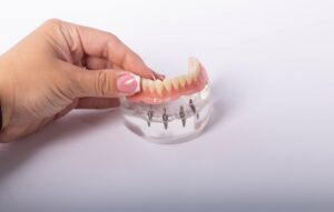 all-on-4 dental implants all-on-4 dental implants