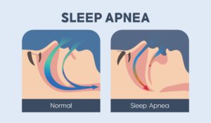shutterstock 2233468711 obstructive sleep apnea diagram