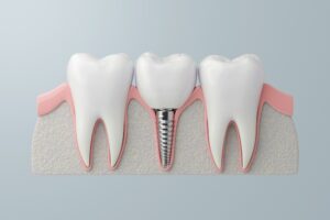 shutterstock 2484606365 dental implant side view
